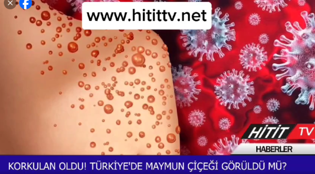 Dünya salgın maymun çiçeği hastalığı ile karşı karşıya