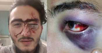 Babasıyla Tartıştı Eve Polis Çağırdı Dayak Yedi 