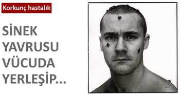 Miyaz hastalığını biliyor musunuz ?