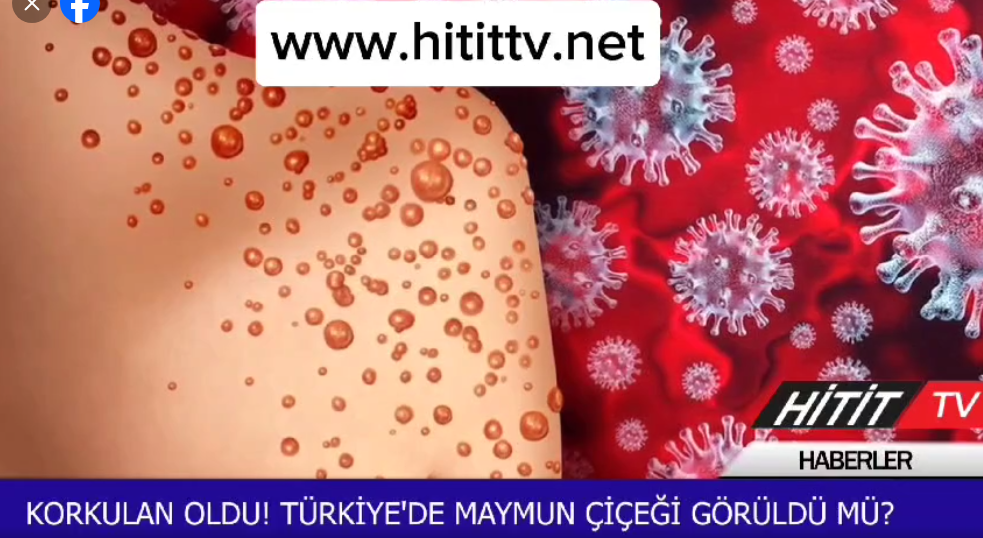 Dünya salgın maymun çiçeği hastalığı ile karş…